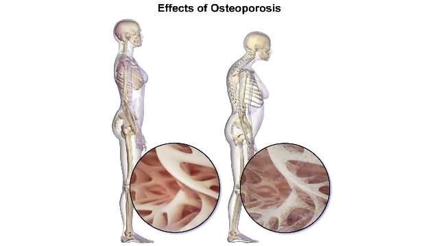 Genetic Screen Predicts Osteoporosis Risk content piece image 