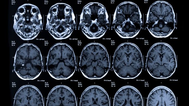Neuroimaging Techniques and What a Brain Image Can Tell Us content piece image 