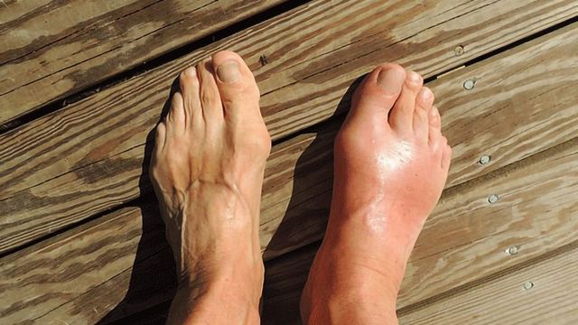  New Target for Treatment of Gout content piece image 